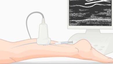 Mögliche Nebenwirkungen der Sklerotherapie, die Sie kennen sollten